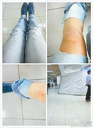 ZH9243航班有乘客逃生时膝盖破皮肿了,为配合治疗裤子被剪成短裤。(网友微博图) 5航班遭诈弹恐吓 航空公司:未考虑赔偿乘客